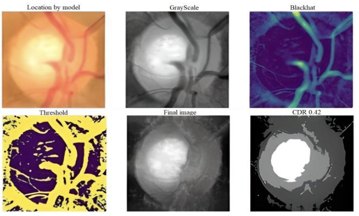 Deep Learning for Glaucoma Detection: R-CNN ResNet-50 and Image Segmentation